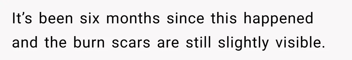 It’s been six months since this happened and the burn scars are still slightly visible.
